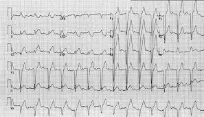 Para ahli percaya bahwa bahan kimia otak tertentu tidak seimbang dapat menyebabkan penyakit. Ekg Part 7 Elevasi Segmen St Dan Penemuan Lain Pada Infark Miokard Difusi Review