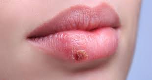 In both men and women it is possible to get herpes sores inside the urethra, the tube that carries urine from the bladder, or in your throat if you have been. Herpes Symptoms Diagnosis Treatment Familydoctor Org
