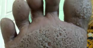 The most likely reason is a fungal infection,two other possible causes include having an illness with a fever, and a disorder called reactive arthritis.other causes include, athlete's foot, athlete's foot, technically known as tinea. Pitted Keratolysis Causes Symptoms And How To Treat It