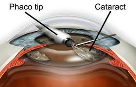 Image result for Cataract Extraction