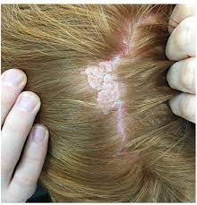 Most of the reported cases have occurred on the face or scalp. Microcystic Adnexal Carcinoma Originating In A Nevus Sebaceous A Case Report Of A 16 Year Old Boy Html Acta Dermato Venereologica