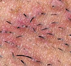 Ask Aaron Q/A: How To Prevent Ingrown Hairs & Razor Bumps | The Shaving  Shack Blog
