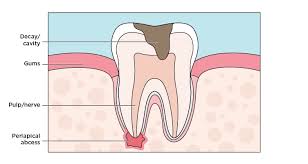Image result for Periodontal Abscess