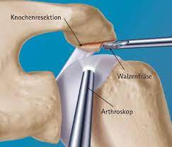 Arthroskopische Schultereingriffe Deutsches Schulterzentrum