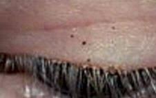 Image result for pubic lice symptoms