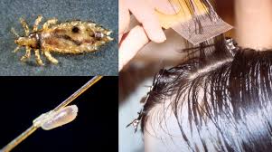 Image result for lice vs nits