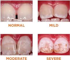 Enamel Hypoplasia Heights Pediatric Dentistry Orthodontics