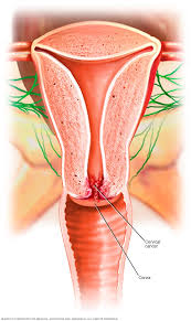 Image result for Cervical Cancer