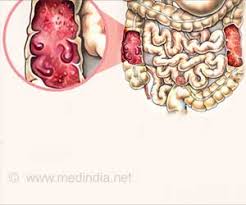 A free online english hindi picture dictionary. Stomach Intestinal Abdominal Tuberculosis Causes Symptoms Diagnosis Treatment