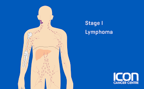 Image result for Lymphoma