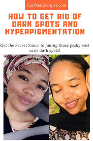 Fade Dark Spots And Hyperpigmentation Acne Dark Spots Skin Care Dark Spots Hyperpigmentation