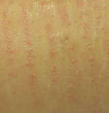 Laser removal treatment takes anywhere from a minute for small areas, such as a woman's upper lip, to a half hour or more for a man's back. Is It Normal If I Have Red Bumps After Laser Hair Removal