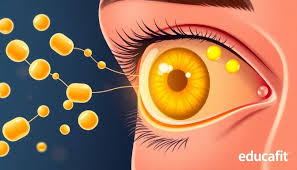 Image result for xantelasma