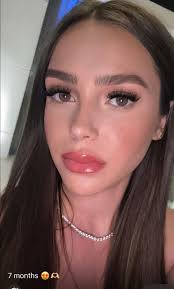 5months after the surgery 🤍🌸