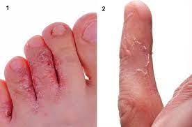 Bubite cu lichid pe maini si picioare. Boli De Piele Cum Le RecunoÈti Pe Cele Mai Importante Foto Boli Si Tratamente SÄnÄtate Unica Ro