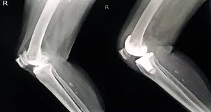 Image result for Knee XRay