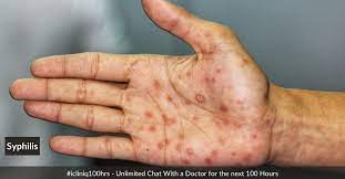 Consult a doctor for medical advice. Syphilis Symptoms Risk Factors Treatments Prevention