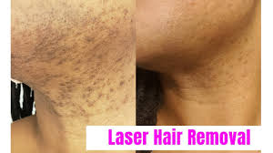 With more than one million procedures performed in 2016, laser hair removal is one of the most popular minimally invasive cosmetic treatments in the laser hair removal shouldn't be performed on tanned skin. Vlog Laser Hair Removal For Black Women Romeo Juliette Laser Hair Removal Youtube