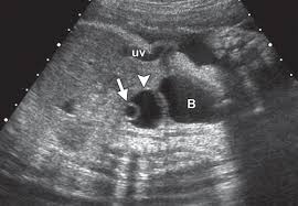 The bizarre thing was, when doctors did the standard ca125 blood test on me, which can detect ovarian cancer, my results came back normal. Fetal Ovarian Cysts Review Of Imaging Spectrum Differential Diagnosis Management And Outcome Radiographics