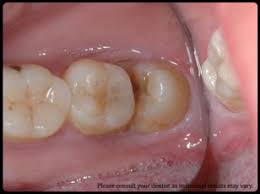 Extraction wisdom tooth are basically tools that help you carry out a successful dental treatment. Dr St Chong Dental Surgery Klinik Pergigian Dr St Chong Home Facebook