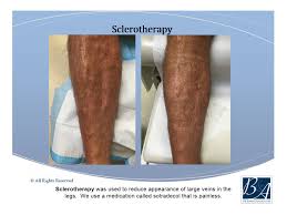 Sotradecol drug & pharmaceuticals active ingredients names and forms, pharmaceutical companies. Sclero Therapy Dr Bawa Associates