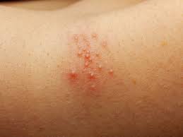 Image result for sweat rash on back