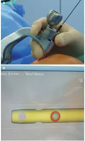 A And 6b Magnetic Targeting System For Blocking Screw Placement Using Download Scientific Diagram