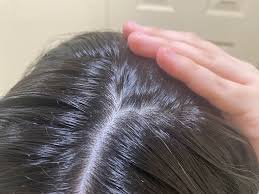 Image result for lice vs dandruff