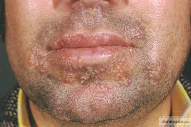 Go on to discover millions of awesome videos and pictures in thousands of other categories. Herpes Infection Clinical Pictures In High Resolution Dermapics Com