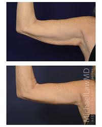 Arm Lift Patient Raleigh Nc Plastic Surgeon Dr Michael Law Raleigh Plastic Surgery Raleigh Plastic Surgeon Co Cosmetic Surgeon Liposuction Plastic Surgeon