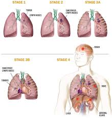 Find information about lung cancer, the deadliest cancer in the united states, from cleveland clinic. Lung Cancer Symptoms Causes Diagnosis Treatment How To Relief