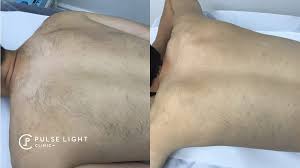 Which clinic are you interested in having this procedure done at and what is its location? Laser Hair Removal Men Pulse Light Clinic London