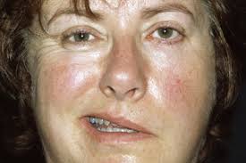 You will likely receive oral steroids to reduce inflammation. Journals Watch Bell S Palsy Flu And Menopause Gponline