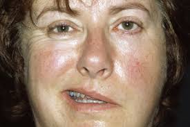 Consult a doctor for medical advice. Journals Watch Bell S Palsy Flu And Menopause Gponline
