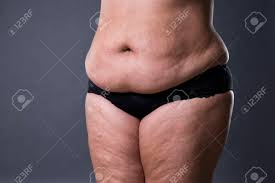 Wenn du etwas mehr isst, dann wird dein auch wenn ich mein bauch normal lasse, ist es oben etwas mehr dicker wie unten. Frau Mit Dicken Bauch Ubergewichtige Weibliche Magen Dehnungsstreifen Auf Bauch Grossansicht Grau Studio Hintergrund Lizenzfreie Fotos Bilder Und Stock Fotografie Image 75405937