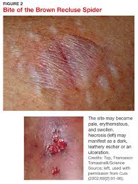 It will usually itch alot at first, and the area of tissue death starts at the site of the bite, and radiates outward from there. Obese Man With Severe Pain And Swollen Hand Clinician Reviews