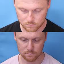 Facial Plastics happy hour with Dr Greg Branham of @washu.ent. We discuss  interesting cases…but mostly we retell some unforgettable stories!