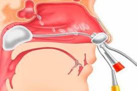 I polipi nasali sono neoformazioni peduncolate, traslucide, caratterizzate da edema, ridotta vascolarizzazione, ridotto numero di ghiandole e terminazioni nervose con proliferazione degli elementi epiteliali e stromali e. Polipi Nel Naso In Un Bambino Sintomi Trattamento Chirurgia Con Competenza Per La Salute Su Ilive