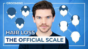 Half of fifty year olds are quite bald. Hair Loss What Stage Are You Youtube