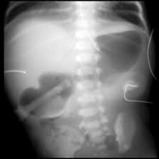 Image result for Midgut Volvulus