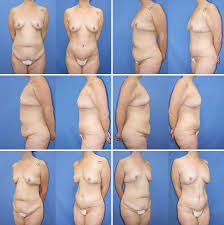 Pin On Brca