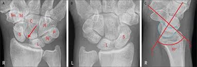 Image result for Scapholunate Dislocation