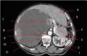 The pain may often be related to nearby organs, such as the heart and stomach. Image Of Axial Section 1 Aorta 2 Left Lung 3 Spleen 4 Stomach 5 Download Scientific Diagram