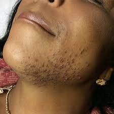 You can greatly reduce the risk of possible side effects by having your treatment performed by a medical doctor who is extremely skilled in using lasers and has. Laser Hair Removal Melbourne Fl Orlando Laser Hair Removal
