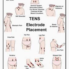 Tens Unit Placement Chart Inspirational Tens Pad Placement