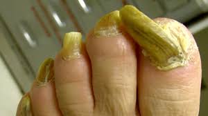 Image result for Yellow nail syndrome feet