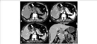 Computed Tomography Findings A An Unenhanced Ct Scan Showed A 4 8 Download Scientific Diagram