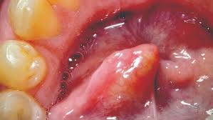 Image result for Sialolithiasis
