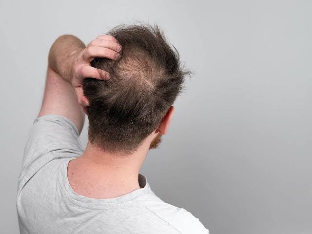Expert Crown Hair Transplant in Turkey Istanbul Surgeons