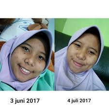 Minum sari kunyit setiap hari agar terhindar dari risiko penyakit leukemia. Wajah Cerah Pake Masker Kunyit